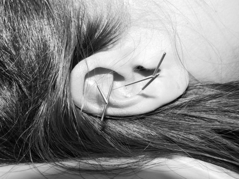 Ear Acupuncture Treatments